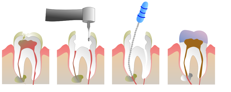 File:Root Canal Illustration Molar.svg